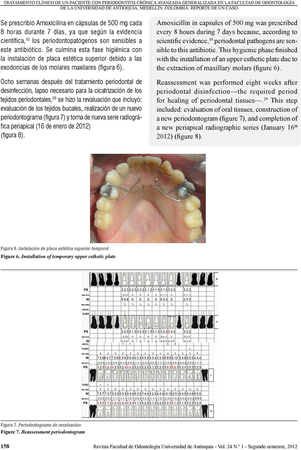 Se culmina esta fase higiénica con la instalación de placa estética superior debido a las exodoncias de los molares maxilares (figura 6).