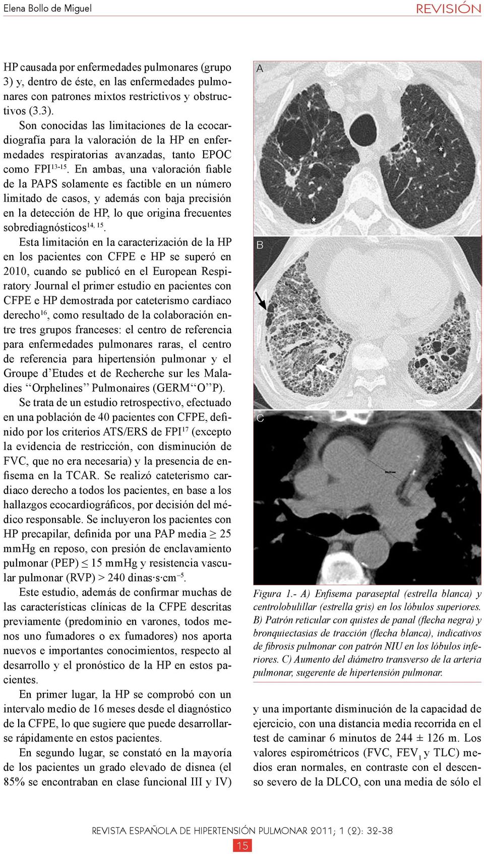 Son conocidas las limitaciones de la ecocardiografía para la valoración de la HP en enfermedades respiratorias avanzadas, tanto EPOC como FPI 13-15.
