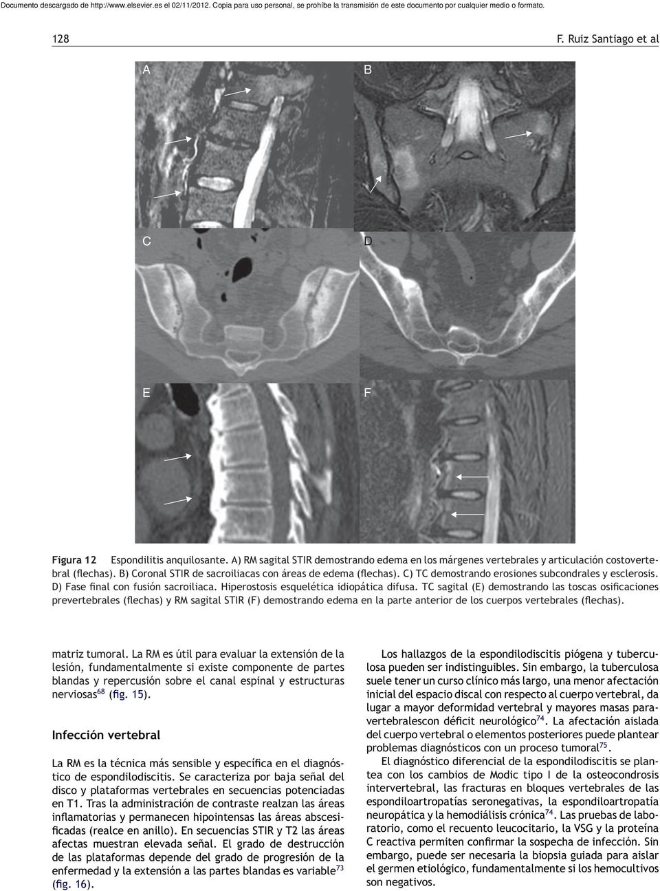 T sagital (E) demostrando las toscas osificaciones prevertebrales (flechas) y RM sagital STIR (F) demostrando edema en la parte anterior de los cuerpos vertebrales (flechas). matriz tumoral.