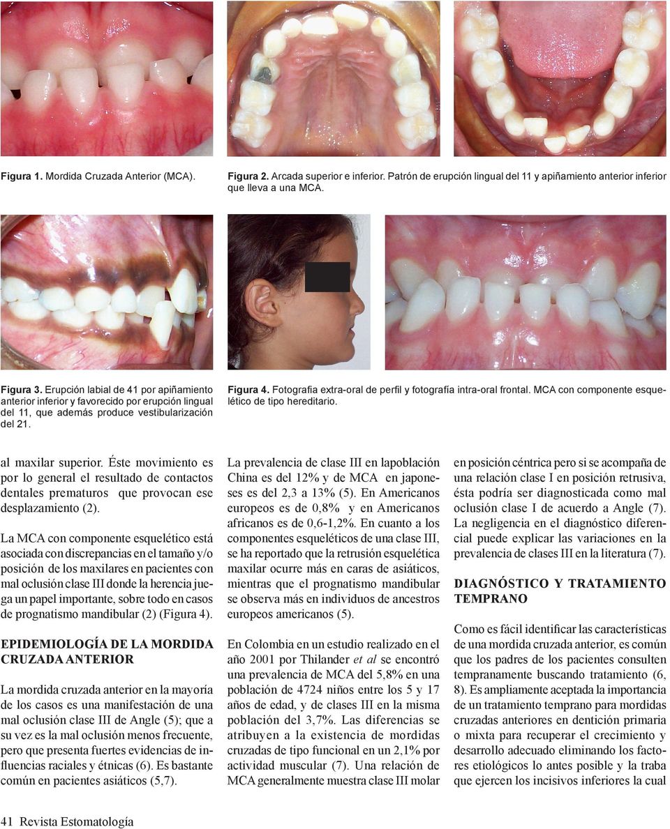Fotografia extra-oral de perfil y fotografía intra-oral frontal. MCA con componente esquelético de tipo hereditario. al maxilar superior.