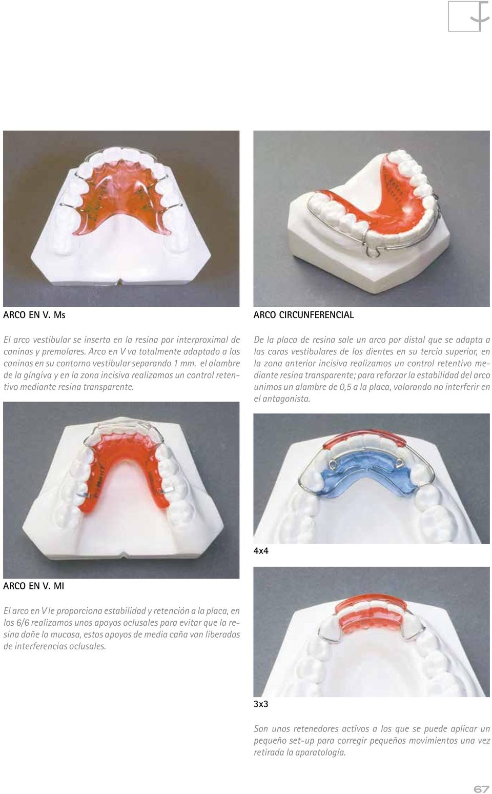 ARCO CIRCUNFERENCIAL De la placa de resina sale un arco por distal que se adapta a las caras vestibulares de los dientes en su tercio superior, en la zona anterior incisiva realizamos un control