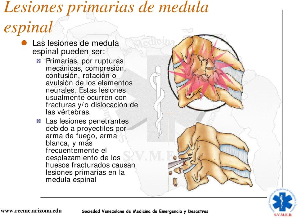 Estas lesiones usualmente ocurren con fracturas y/o dislocación de las vértebras.