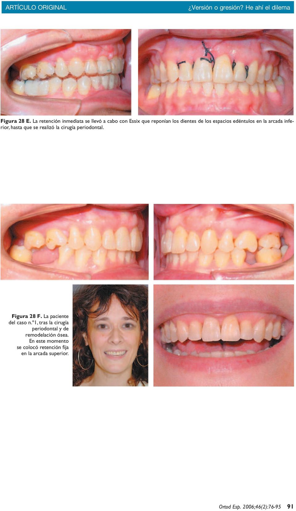 en la arcada inferior, hasta que se realizó la cirugía periodontal. Figura 28 F.