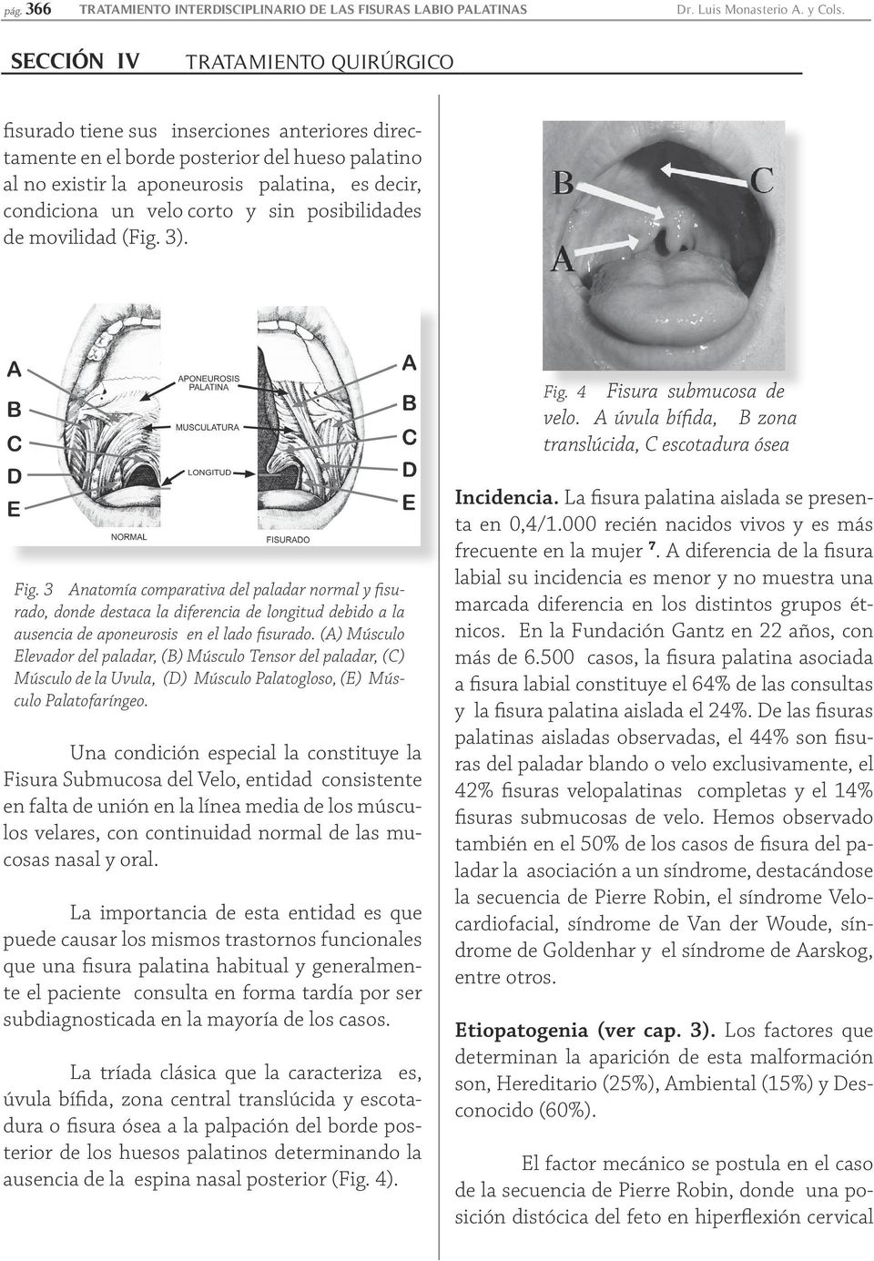 movilidad (Fig. 3). Fig. 4 Fisura submucosa de velo. A úvula bífida, B zona translúcida, C escotadura ósea Fig.