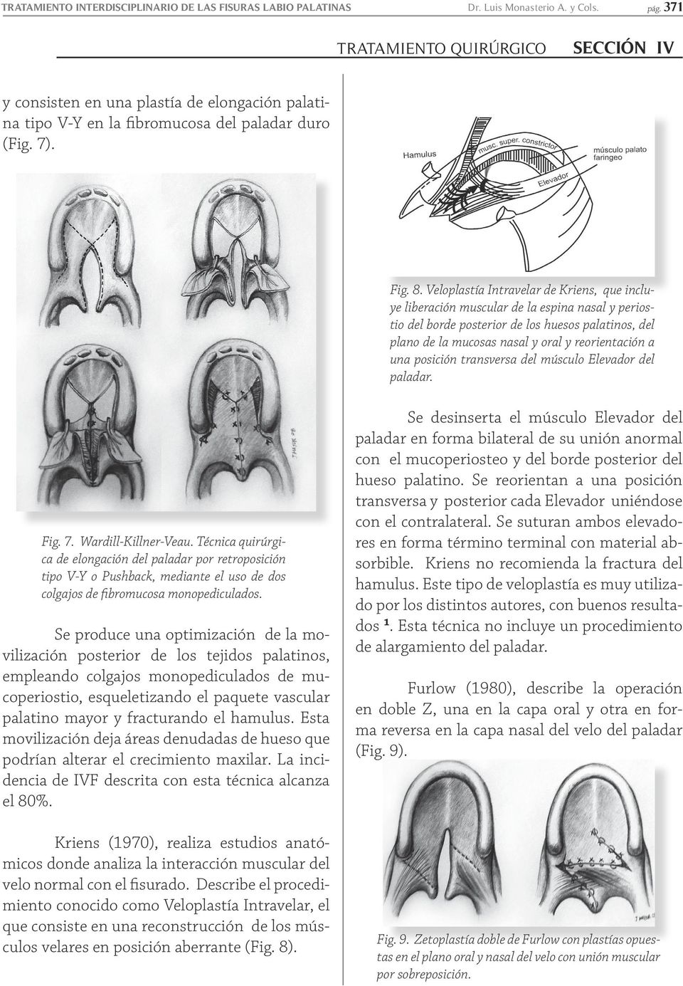 Veloplastía Intravelar de Kriens, que incluye liberación muscular de la espina nasal y periostio del borde posterior de los huesos palatinos, del plano de la mucosas nasal y oral y reorientación a