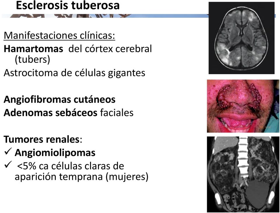 Angiofibromas cutáneos Adenomas sebáceos faciales Tumores