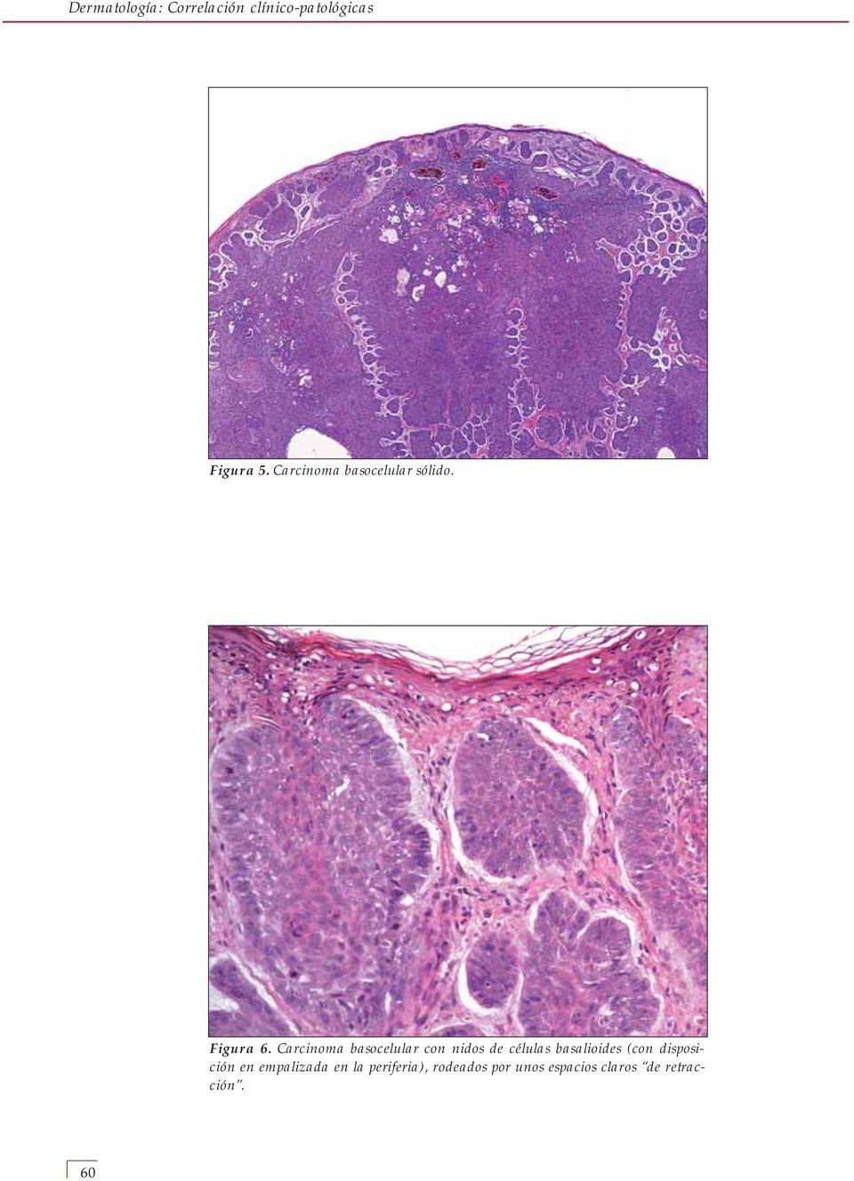Carcinoma basocelular con nidos de células basalioides (con