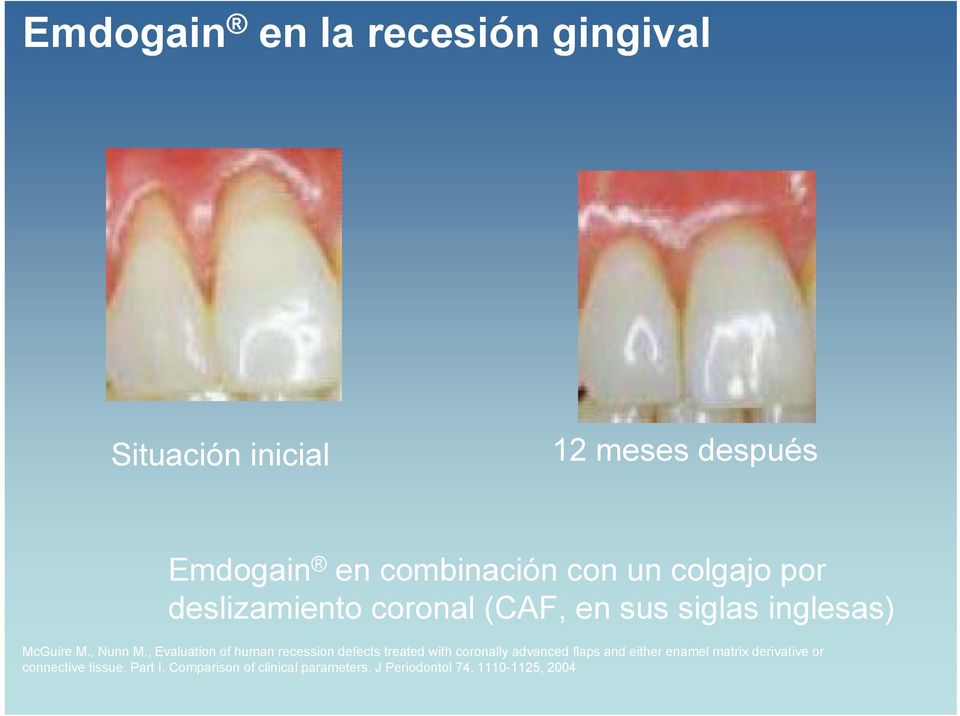 , Evaluation of human recession defects treated with coronally advanced flaps and either enamel