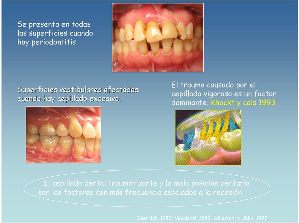 Khockt y cols 1993 El cepillado dental traumatizante y la mala posición dentaria son los factores