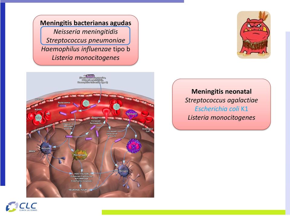 Listeria monocitogenes Meningitis neonatal