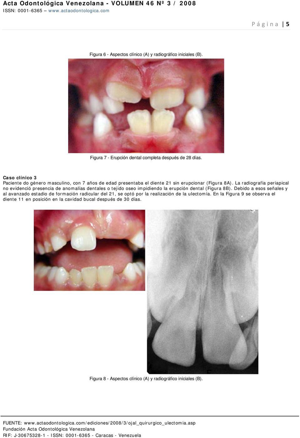 La radiografía periapical no evidenció presencia de anomalías dentales o tejido oseo impidiendo la erupción dental (Figura 8B).