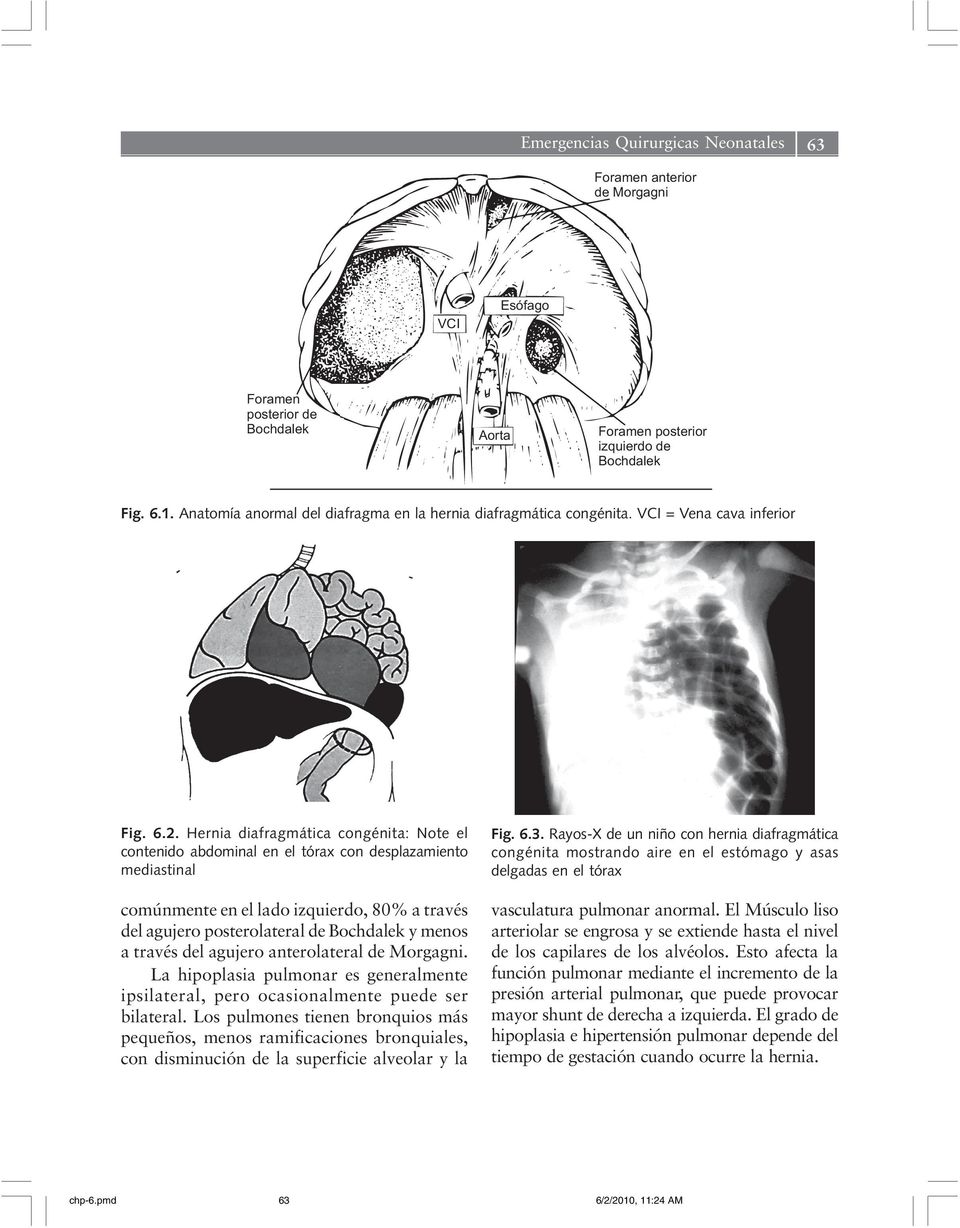 Hernia diafragmática congénita: Note el contenido abdominal en el tórax con desplazamiento mediastinal comúnmente en el lado izquierdo, 80% a través del agujero posterolateral de Bochdalek y menos a