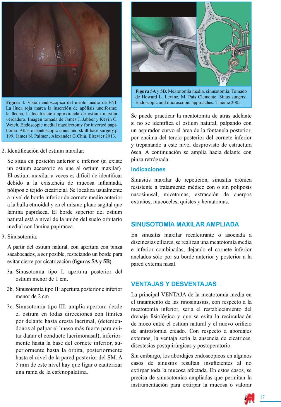 Elsevier 2013. 2. Identificación del ostium maxilar: Se sitúa en posición anterior e inferior (si existe un ostium accesorio se une al ostium maxilar).