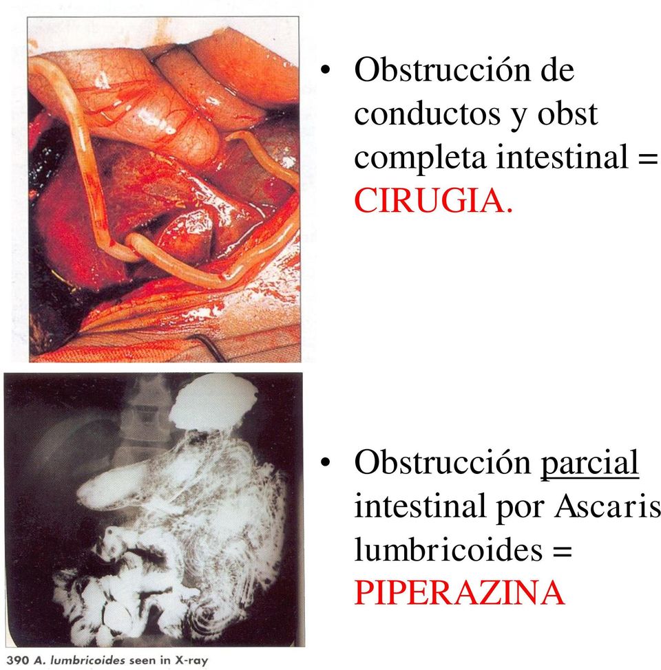Obstrucción parcial intestinal