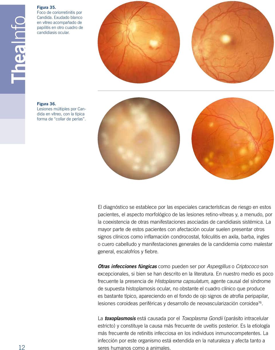 El diagnóstico se establece por las especiales características de riesgo en estos pacientes, el aspecto morfológico de las lesiones retino-vítreas y, a menudo, por la coexistencia de otras