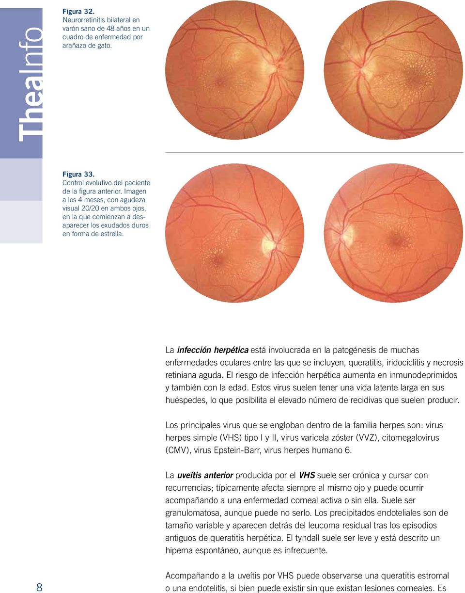 La infección herpética está involucrada en la patogénesis de muchas enfermedades oculares entre las que se incluyen, queratitis, iridociclitis y necrosis retiniana aguda.