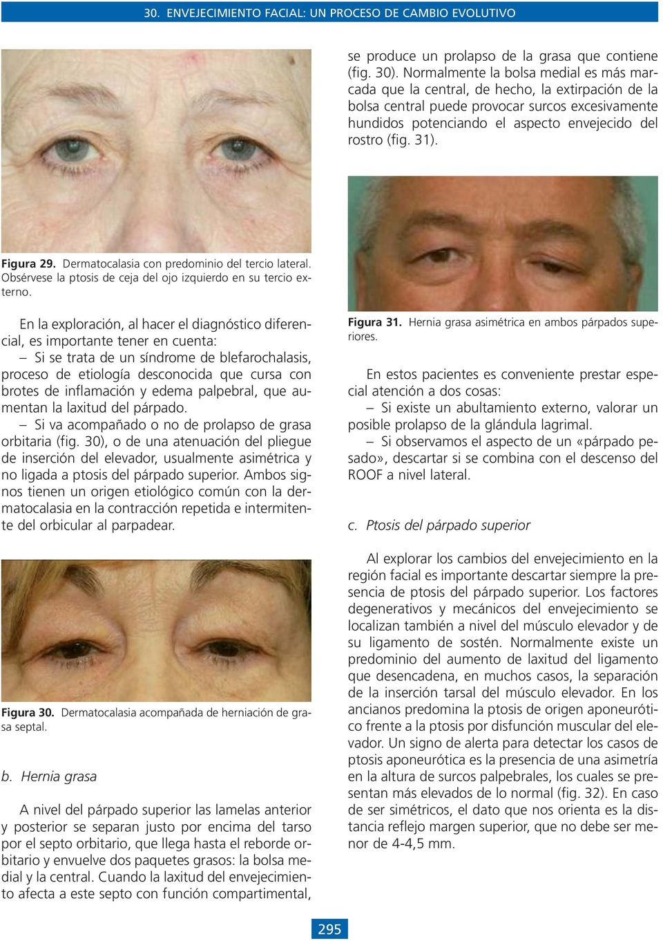 31). Figura 29. Dermatocalasia con predominio del tercio lateral. Obsérvese la ptosis de ceja del ojo izquierdo en su tercio externo.