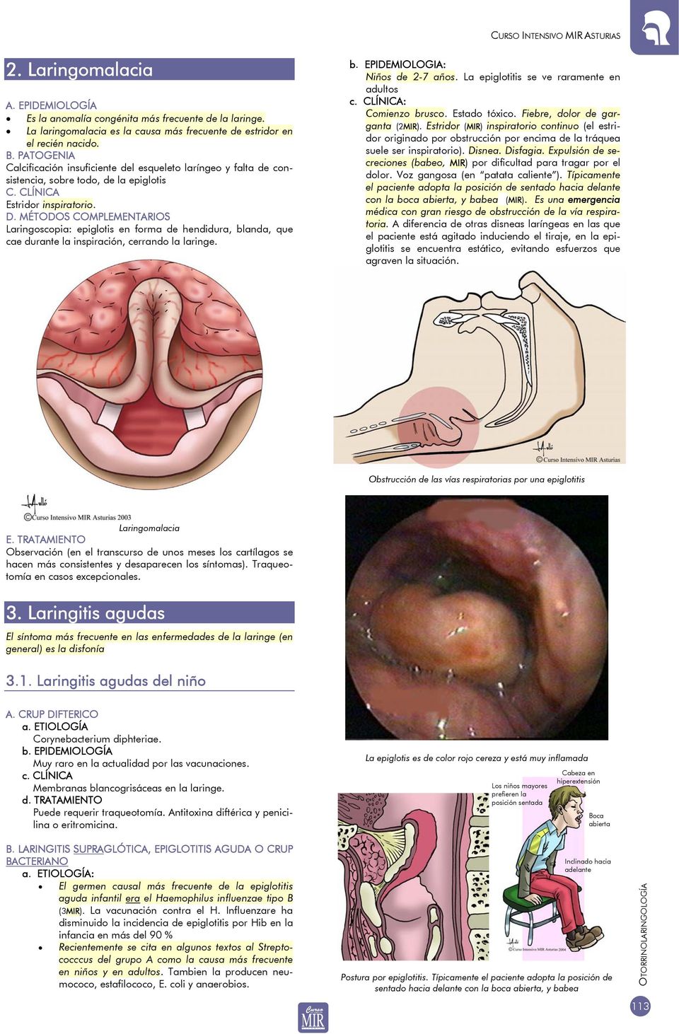 MÉTODOS COMPLEMENTARIOS Laringoscopia: epiglotis en forma de hendidura, blanda, que cae durante la inspiración, cerrando la laringe. b. EPIDEMIOLOGIA: Niños de 2-7 años.
