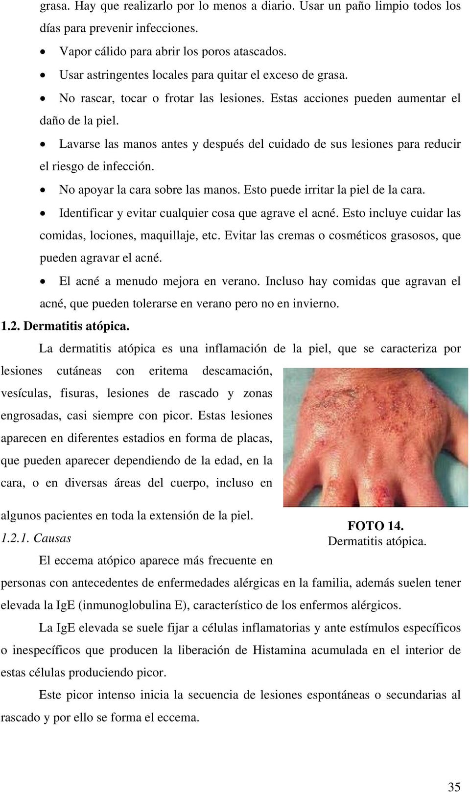 Lavarse las manos antes y después del cuidado de sus lesiones para reducir el riesgo de infección. No apoyar la cara sobre las manos. Esto puede irritar la piel de la cara.