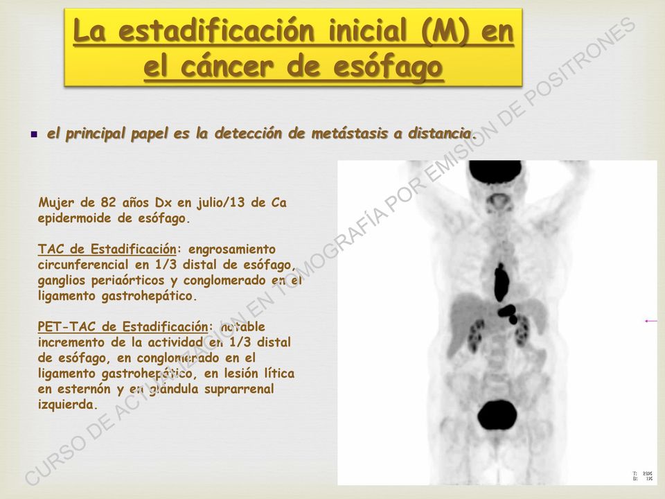 TAC de Estadificación: engrosamiento circunferencial en 1/3 distal de esófago, ganglios periaórticos y conglomerado en el ligamento