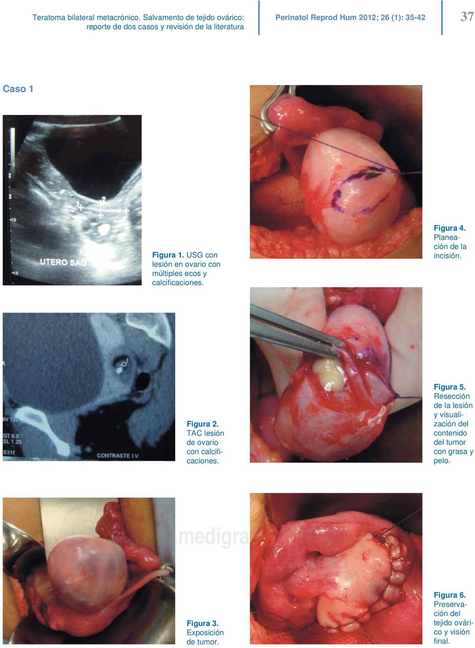 USG con lesión en ovario con múltiples ecos y calcifi caciones. Figura 4. Planeación de la incisión. Figura 2.