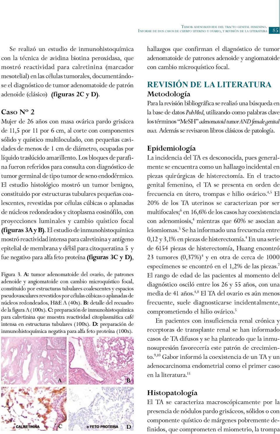 calretinina (marcador mesotelial) en las células tumorales, documentándose el diagnóstico de tumor adenomatoide de patrón adenoide (clásico) (figuras 2C y D).