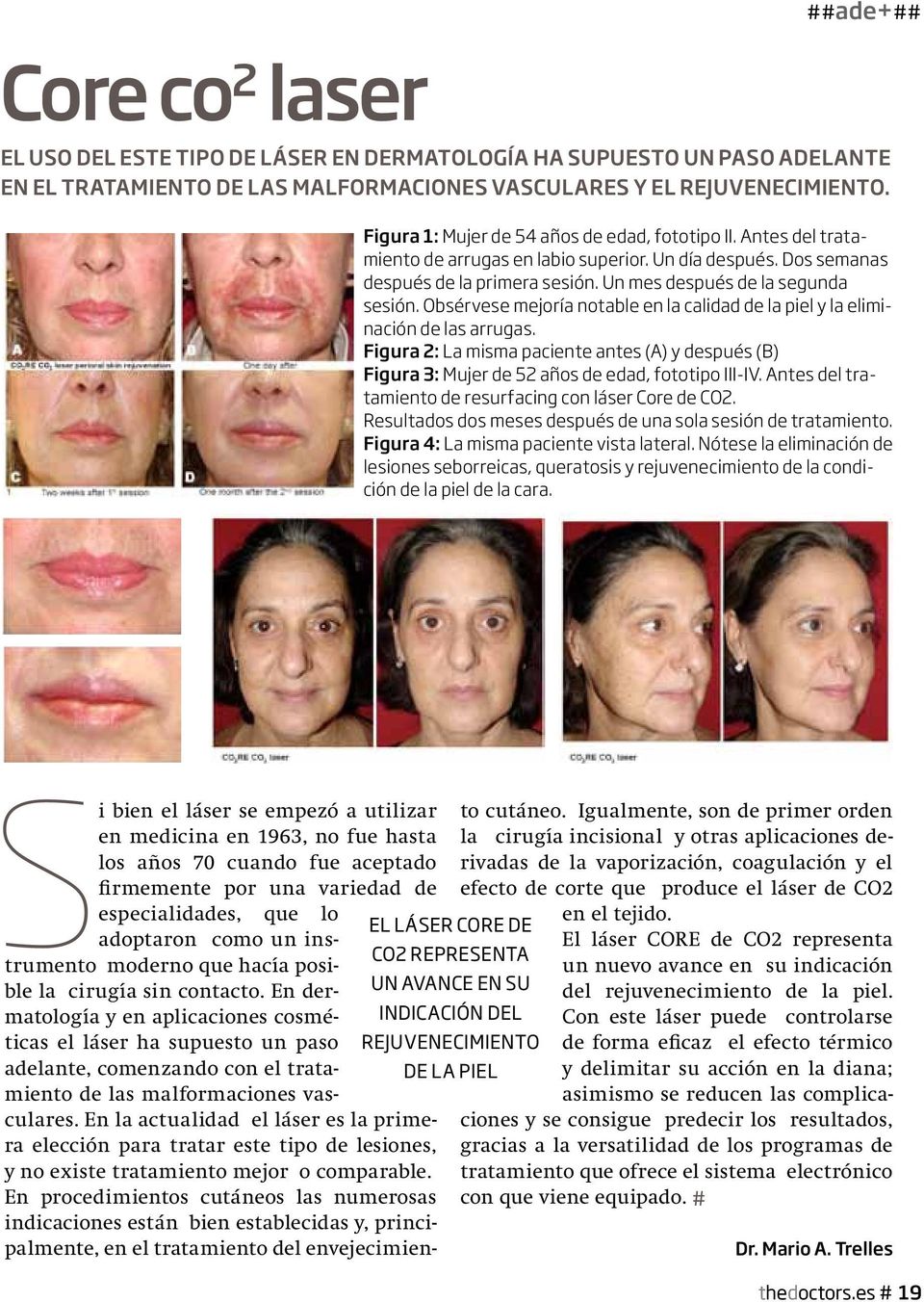 Obsérvese mejoría notable en la calidad de la piel y la eliminación de las arrugas. Figura 2: La misma paciente antes (A) y después (B) Figura 3: Mujer de 52 años de edad, fototipo III-IV.