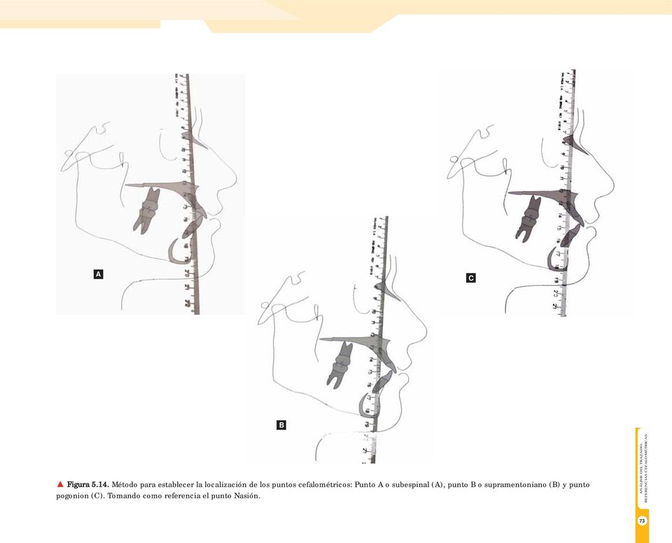 cefalométricos: Punto A o subespinal (A), punto B o
