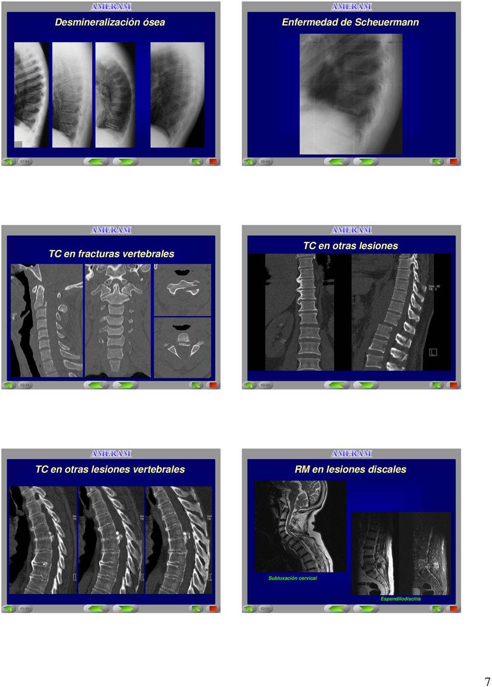 39/44 40/44 TC en otras lesiones vertebrales RM en