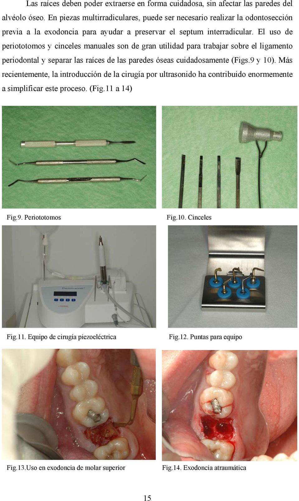 El uso de periototomos y cinceles manuales son de gran utilidad para trabajar sobre el ligamento periodontal y separar las raíces de las paredes óseas cuidadosamente (Figs.9 y 10).