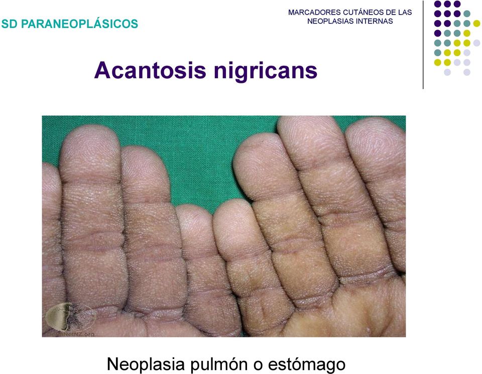 Acantosis