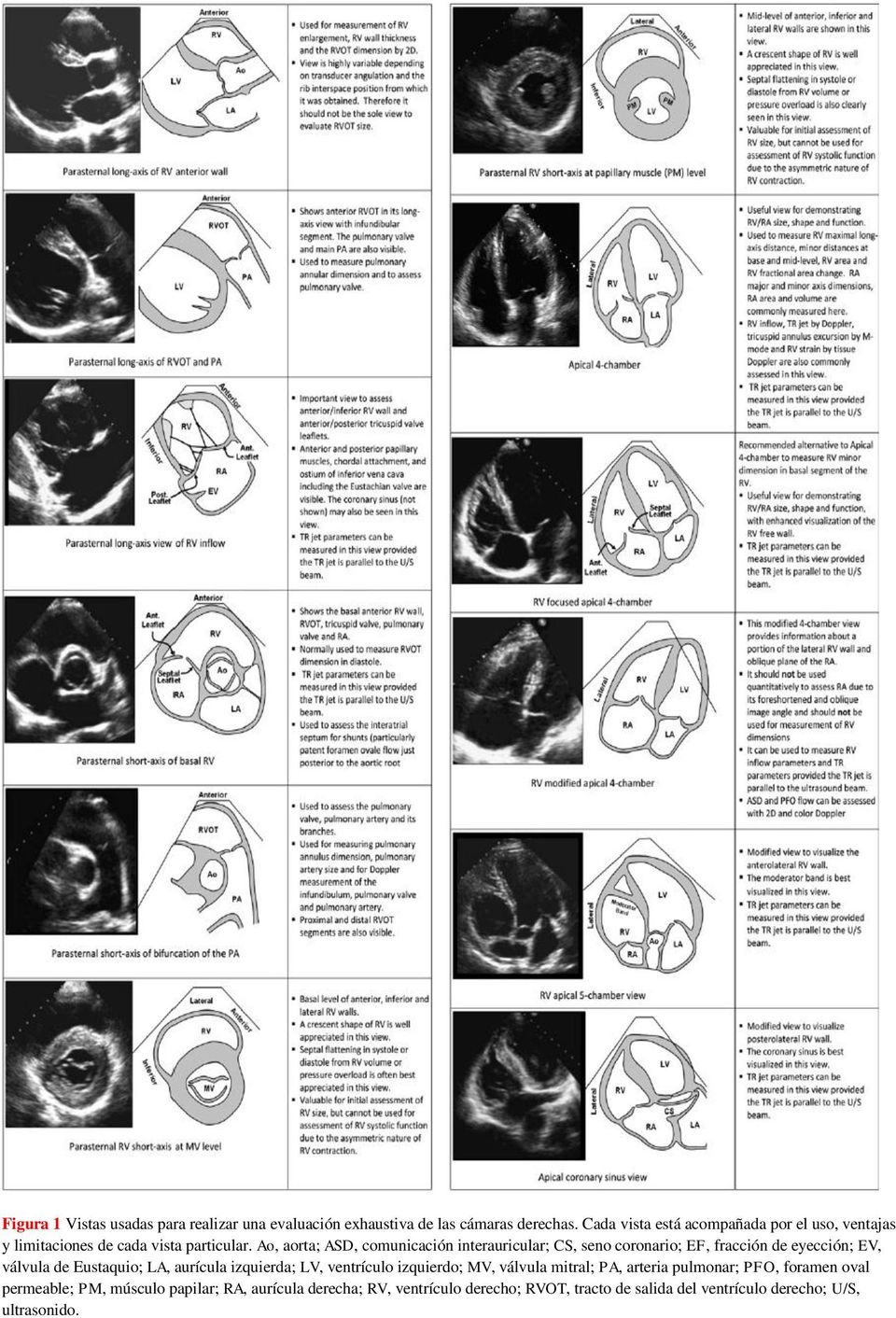 Ao, aorta; ASD, comunicación interauricular; CS, seno coronario; EF, fracción de eyección; EV, válvula de Eustaquio; LA, aurícula
