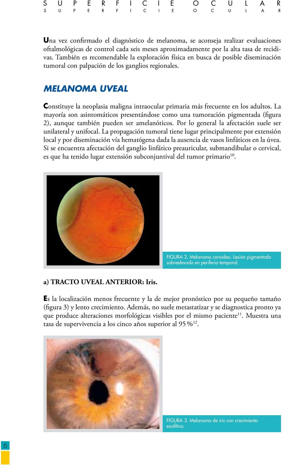 MELANOMA UVEAL Constituye la neoplasia maligna intraocular primaria más frecuente en los adultos.