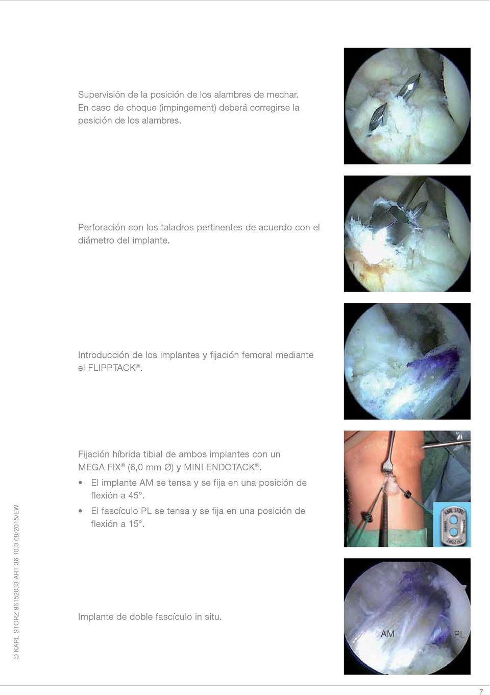 Introducción de los implantes y fijación femoral mediante el FLIPPTACK.