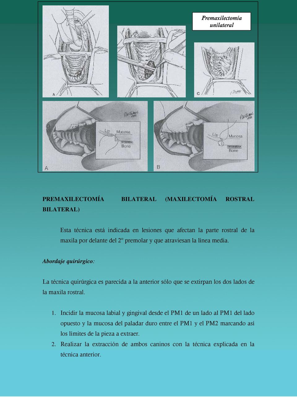 Abordaje quirúrgico: La técnica quirúrgica es parecida a la anterior sólo que se extirpan los dos lados de la maxila rostral. 1.