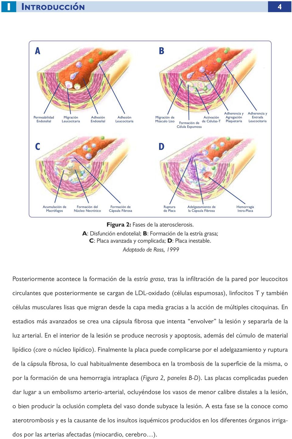 Cápsula Fibrosa Hemorragia Intra-Placa Figura 2: Fases de la aterosclerosis. A: Disfunción endotelial; B: Formación de la estría grasa; C: Placa avanzada y complicada; D: Placa inestable.