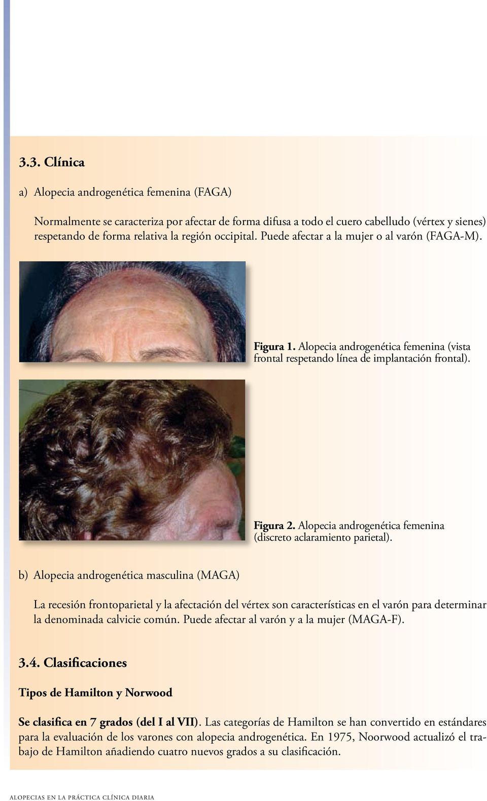 Alopecia androgenética femenina (discreto aclaramiento parietal).