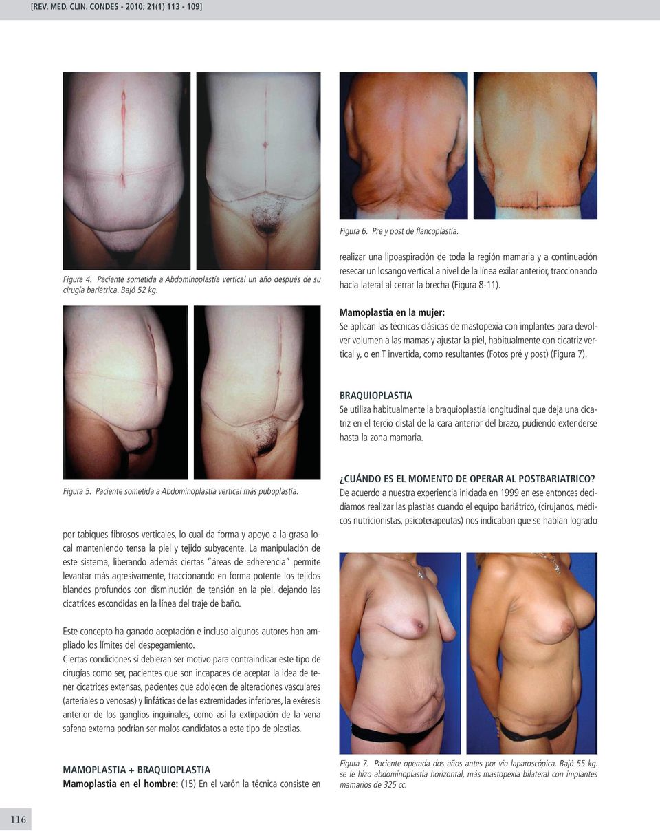 Mamoplastia en la mujer: Se aplican las técnicas clásicas de mastopexia con implantes para devolver volumen a las mamas y ajustar la piel, habitualmente con cicatriz vertical y, o en T invertida,