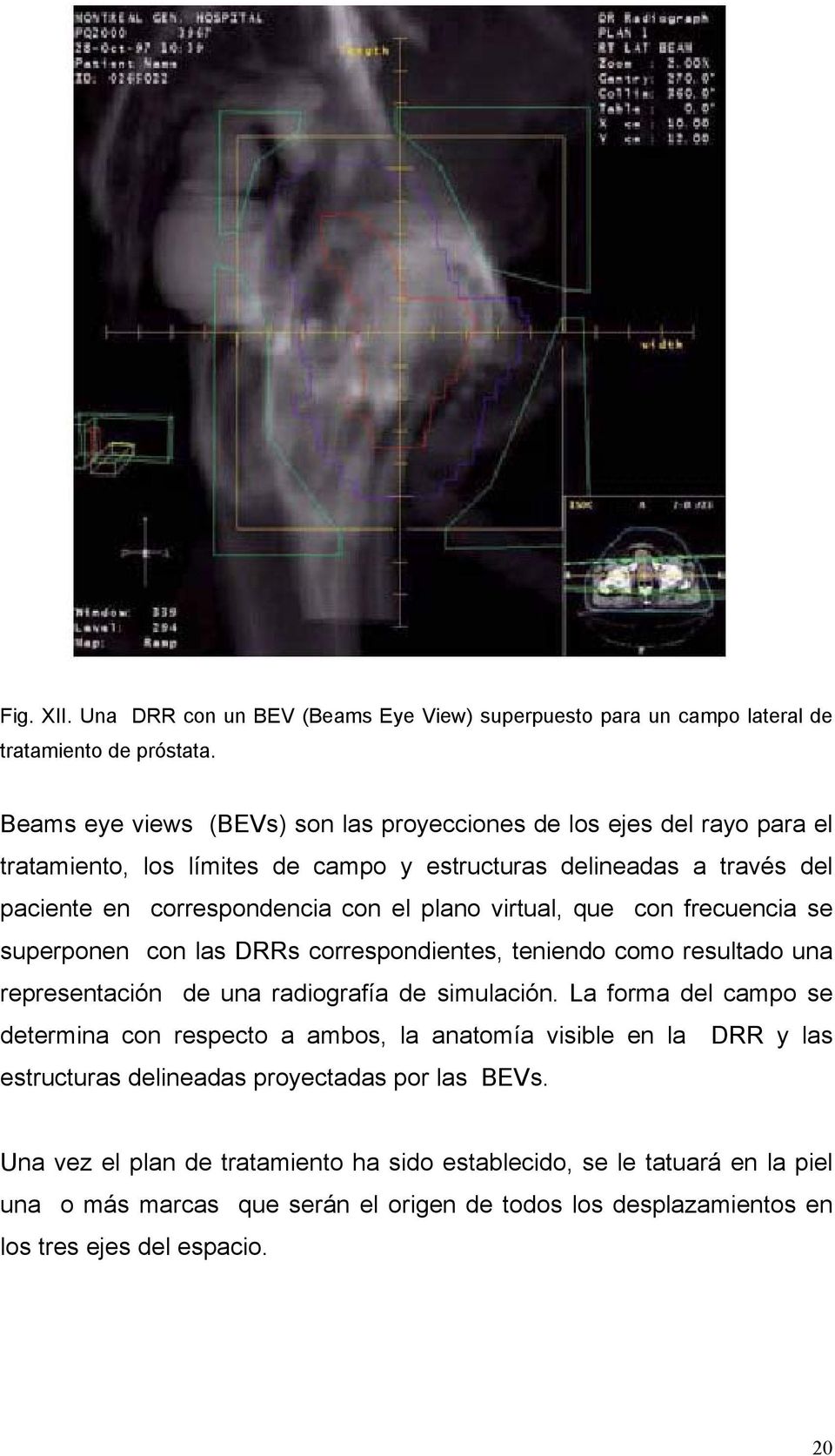 virtual, que con frecuencia se superponen con las DRRs correspondientes, teniendo como resultado una representación de una radiografía de simulación.