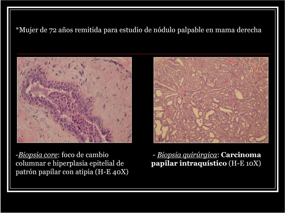 hiperplasia epitelial de patrón papilar con atipia (H-E