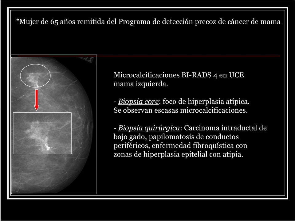 - Biopsia core: foco de hiperplasia atípica. Se observan escasas microcalcificaciones.