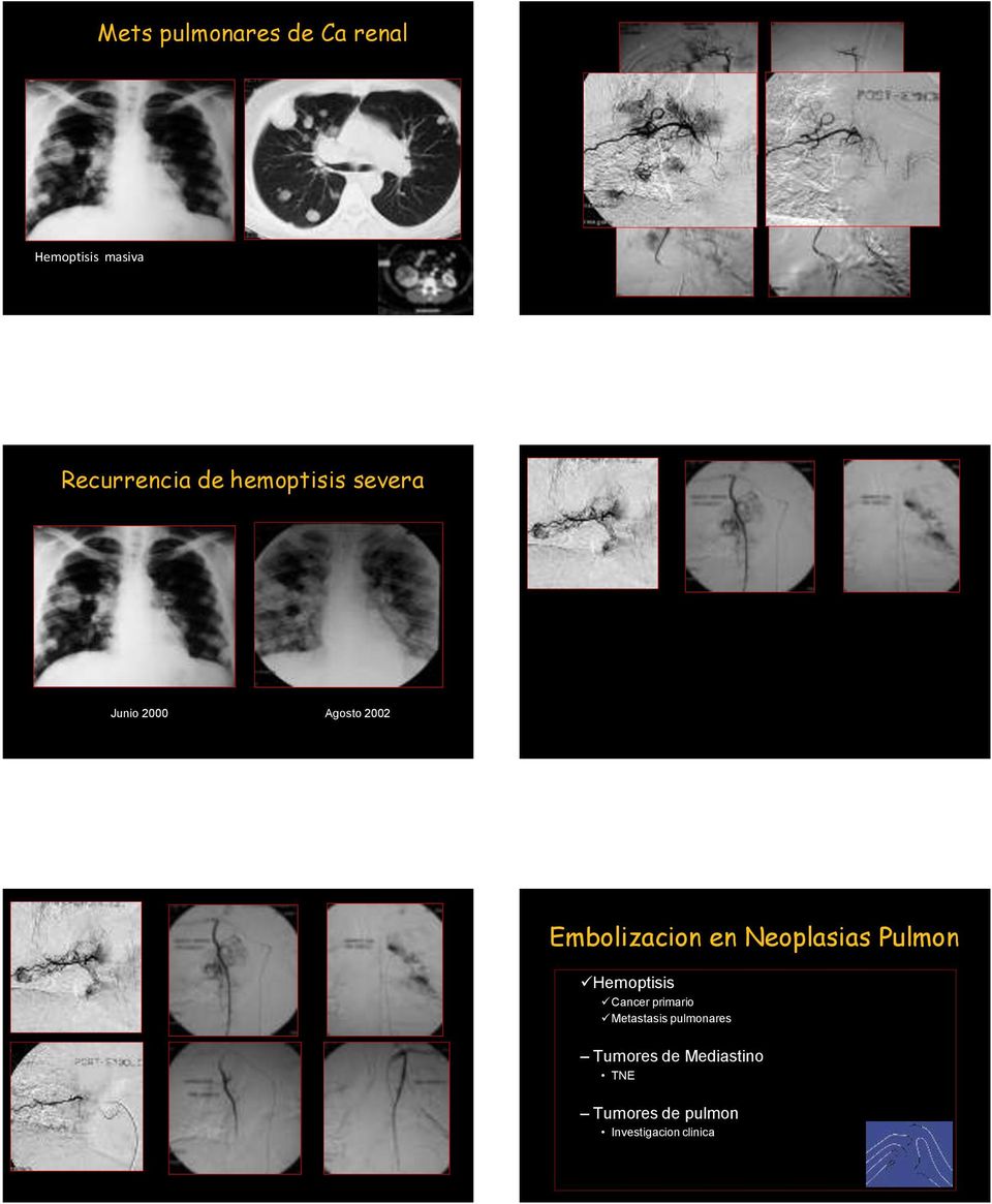 Neoplasias Pulmon Hemoptisis Cancer primario Metastasis