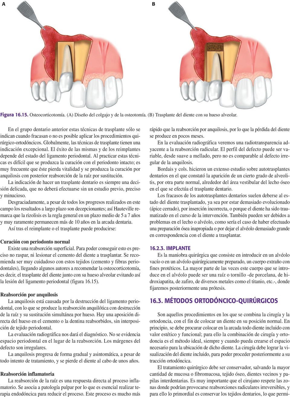 Globalmente, las técnicas de trasplante tienen una indicación excepcional. El éxito de las mismas y de los reimplantes depende del estado del ligamento periodontal.