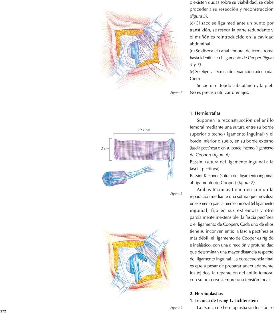 (d) Se diseca el canal femoral de forma roma hasta identificar el ligamento de Cooper (figura 4 y 5). (e) Se elige la técnica de reparación adecuada. Cierre. Se cierra el tejido subcutáneo y la piel.