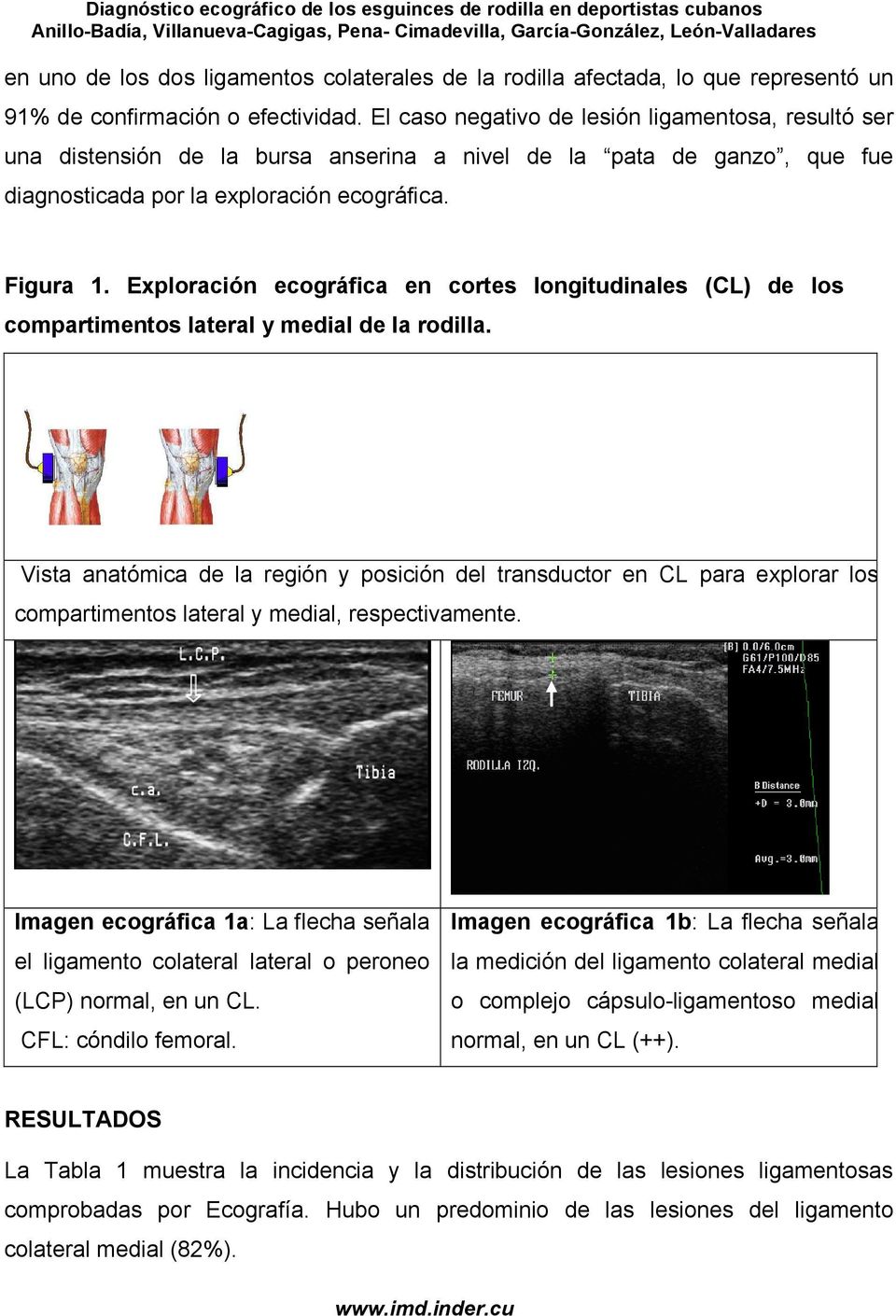 Exploración ecográfica en cortes longitudinales (CL) de los compartimentos lateral y medial de la rodilla.