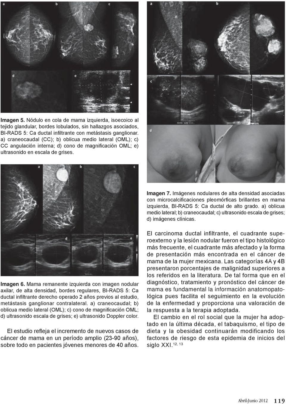 Imágenes nodulares de alta densidad asociadas con microcalcificaciones pleomórficas brillantes en mama izquierda, BI-RADS 5: Ca ductal de alto grado.