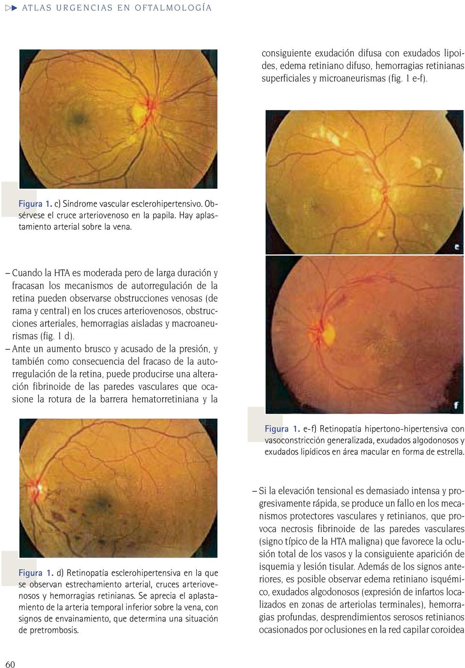 Cuando la HTA es moderada pero de larga duración y fracasan los mecanismos de autorregulación de la retina pueden observarse obstrucciones venosas (de rama y central) en los cruces arteriovenosos,