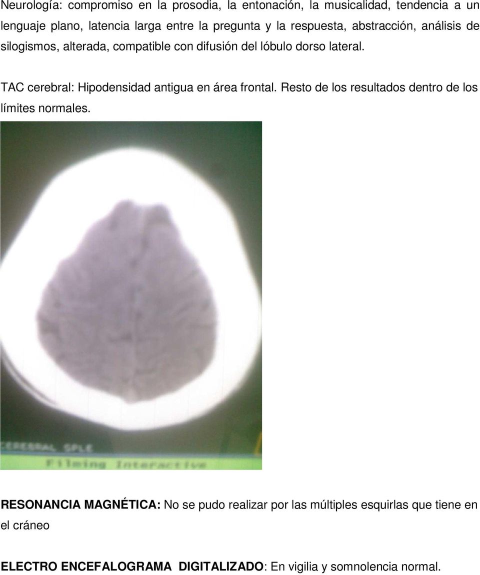 TAC cerebral: Hipodensidad antigua en área frontal. Resto de los resultados dentro de los límites normales.
