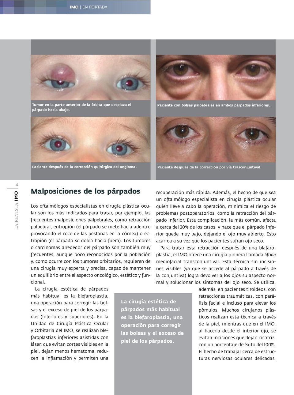4 Malposiciones de los párpados Los oftalmólogos especialistas en cirugía plástica ocular son los más indicados para tratar, por ejemplo, las frecuentes malposiciones palpebrales, como retracción