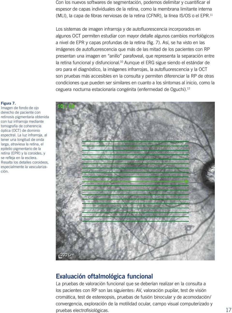 11 Los sistemas de imagen infrarroja y de autofluorescencia incorporados en algunos OCT permiten estudiar con mayor detalle algunos cambios morfológicos a nivel de EPR y capas profundas de la retina